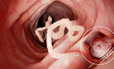 Como reconhecer a presença de parasitas no intestino humano